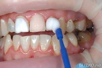 Прием стоматолога-гигиениста