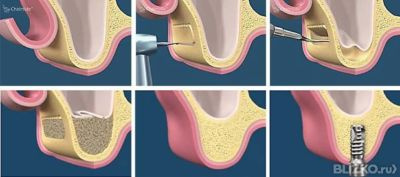 Пластика кости при имплантации зуба