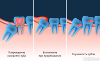Удаление зуба мудрости