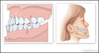 Исправление прикуса диагностикой со слепками